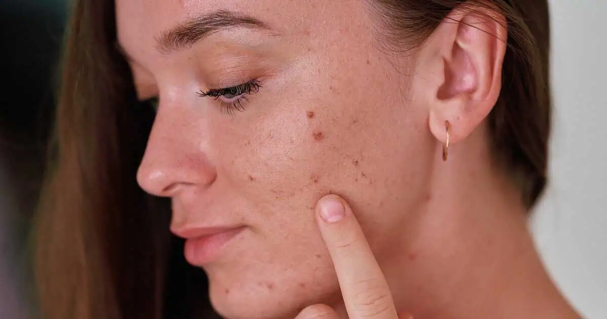 Mulher jovem de pele clara com acne tocando a bochecha