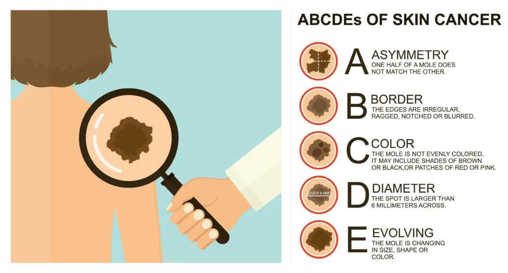 Desenho com pessoa sendo examina com uma lupa à esquerda e uma explicação do ABCDE do melanoma à direita